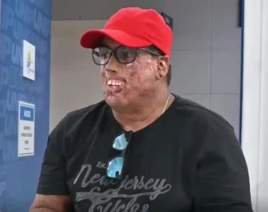 Homem com doença rara passa por 230 cirurgias no rosto e ganha prótese