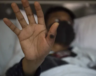O que se sabe sobre a nova variante de Mpox identificada no Brasil