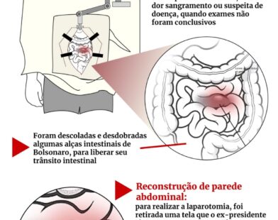 obstrução intestinal