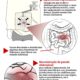 obstrução intestinal