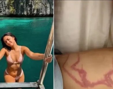 Influencer é picada por espécie de água-viva "mais venenosa" do mundo