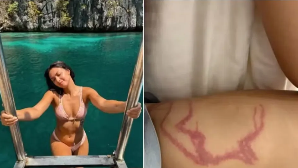 Influencer é picada por espécie de água-viva "mais venenosa" do mundo