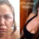 Mulher perde parte da audição após ser espancada por 2 horas por seu ex
