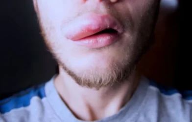 Mais de 1,2 mil pessoas têm reação a pasta Colgate; venda segue proibida