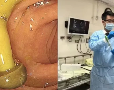 Médico descobre cogumelo crescendo no intestino de paciente