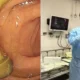 Médico descobre cogumelo crescendo no intestino de paciente